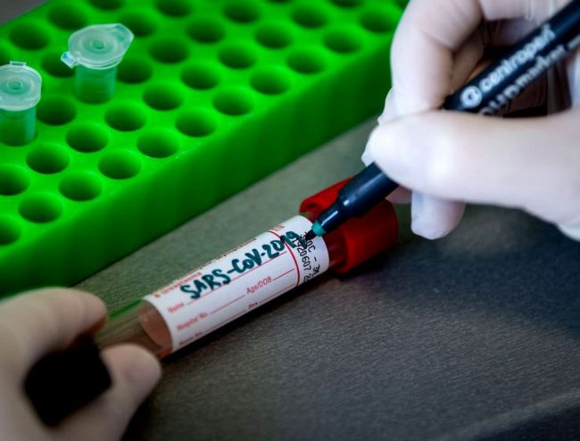 test-coronavirus-covid19-SERJMIN
